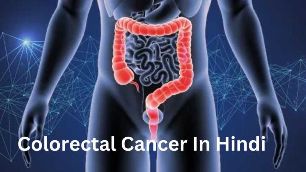 Colorectal Cancer In Hindi