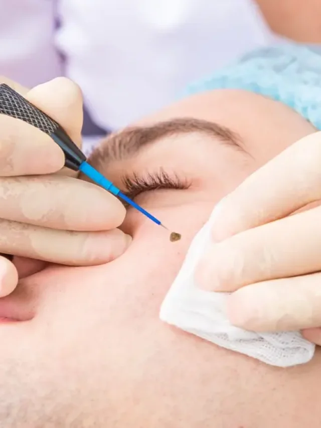 How to Remove Skin Tags, According to Dermatologists