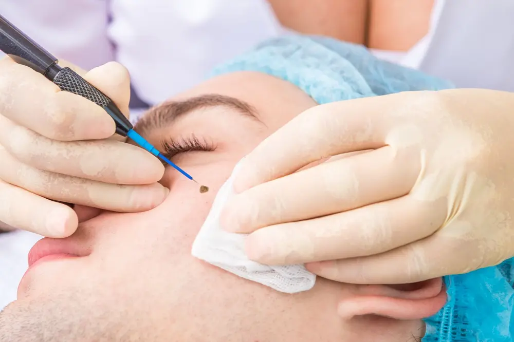 How to Remove Skin Tags, According to Dermatologists